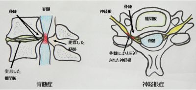 頚椎症(肩、腕や手の痛みやしびれ、こわばり)　甲賀市　寺庄整骨院でよく診る症例シリーズ
